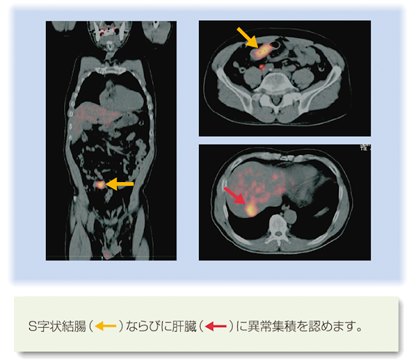 PET/CT検査写真：大腸癌肝転移