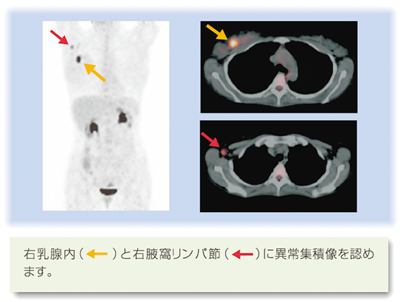 PET/CT検査写真：乳癌腋寓リンパ節転移